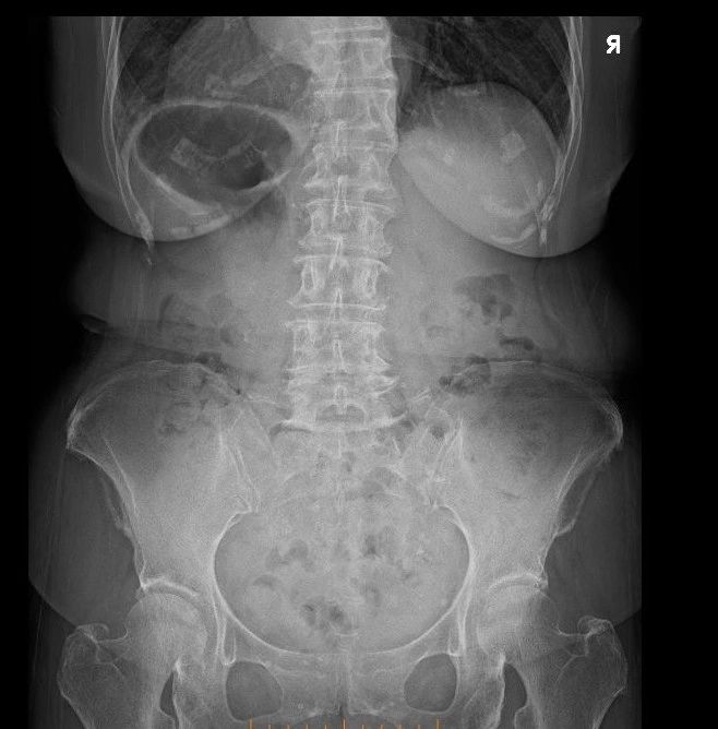 Spinal X-ray used to diagnose and plan care